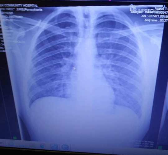 Shocking X rays show how vaping left teen s lungs caked with