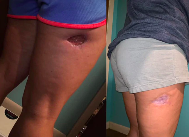 Shocking photos of woman's year-long recovery from a spider bite - NZ Herald